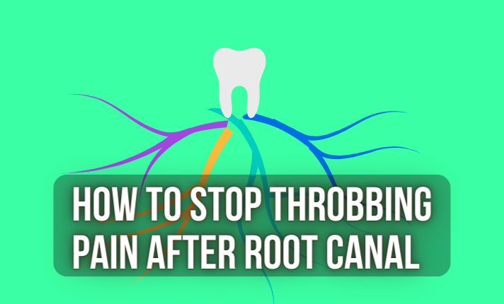 how to stop throbbing pain after root canal