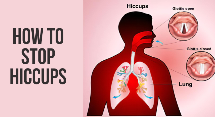 how to stop hiccups